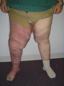 After lymphedema treatment