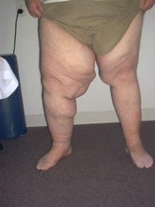 Lymphedema before treatment