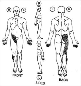 SI-joint-pain-pattern