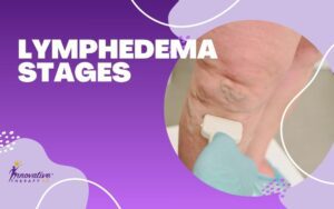 lymphedema-stages-guide-featured image-v2