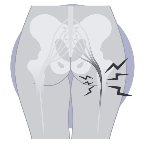 sciatic-nerve-pain-element