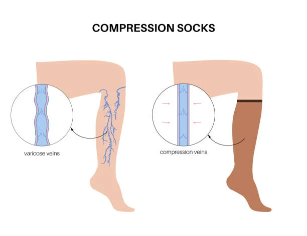 How Compression Garments Aid in Physical Therapy