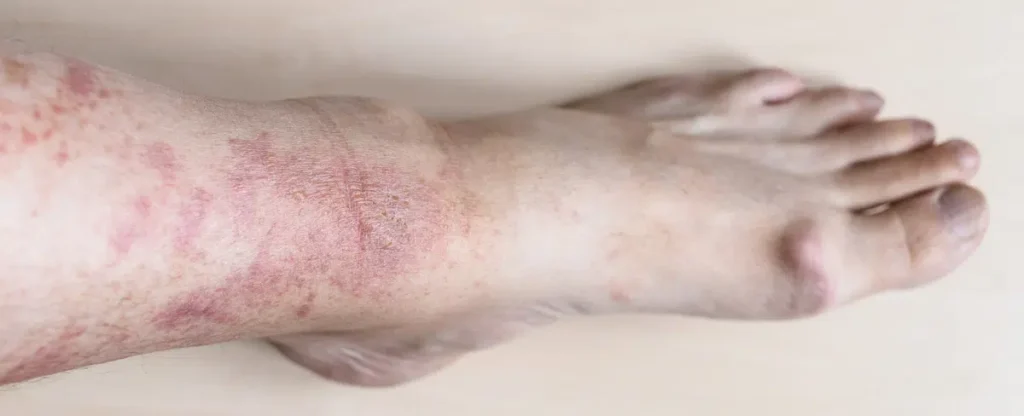 lymphedema-cellulitis-treatment